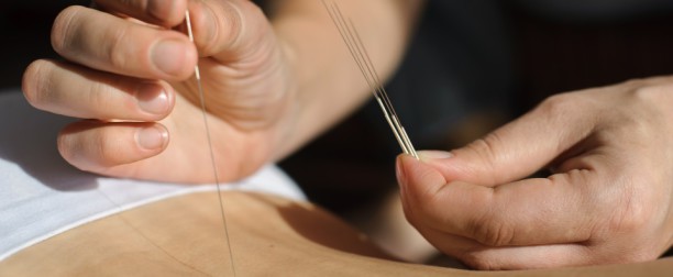 Dry Needling