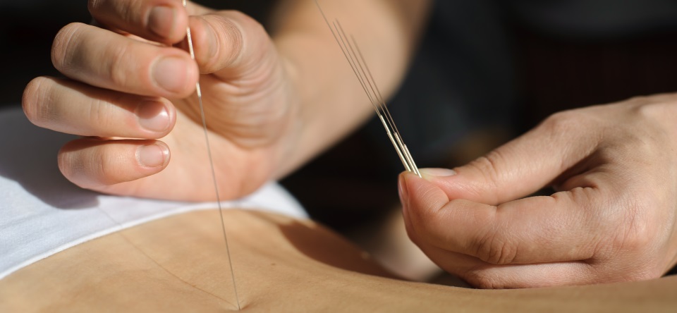 Dry Needling